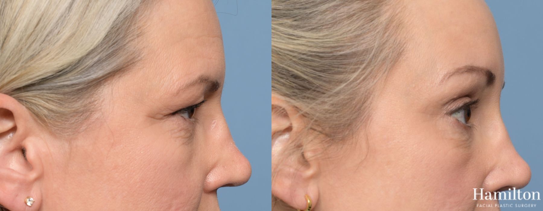 Before and after Blepharoplasty case 37175 - Angle 3