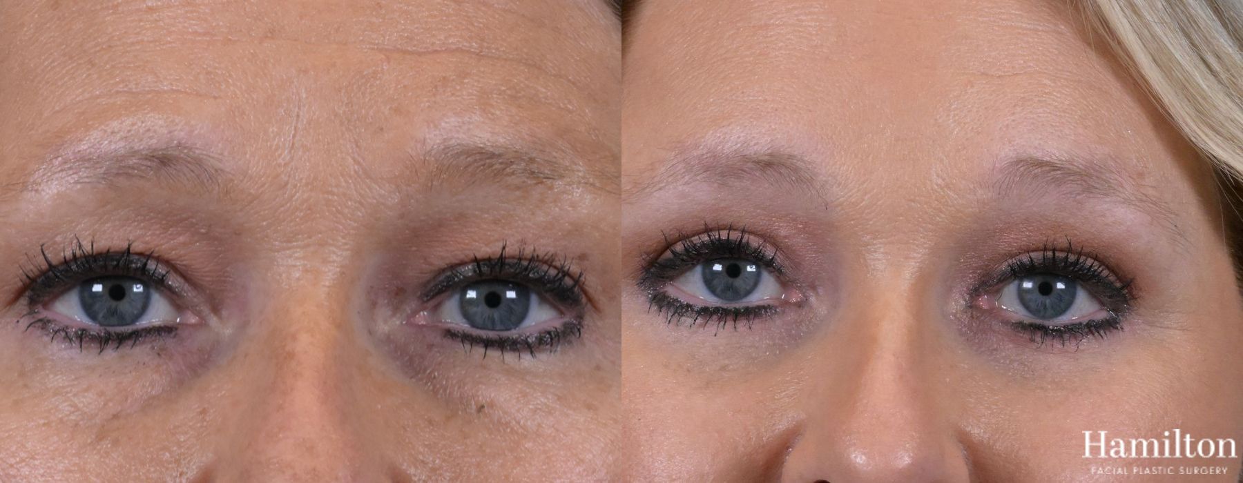 Before and after Blepharoplasty case 37227