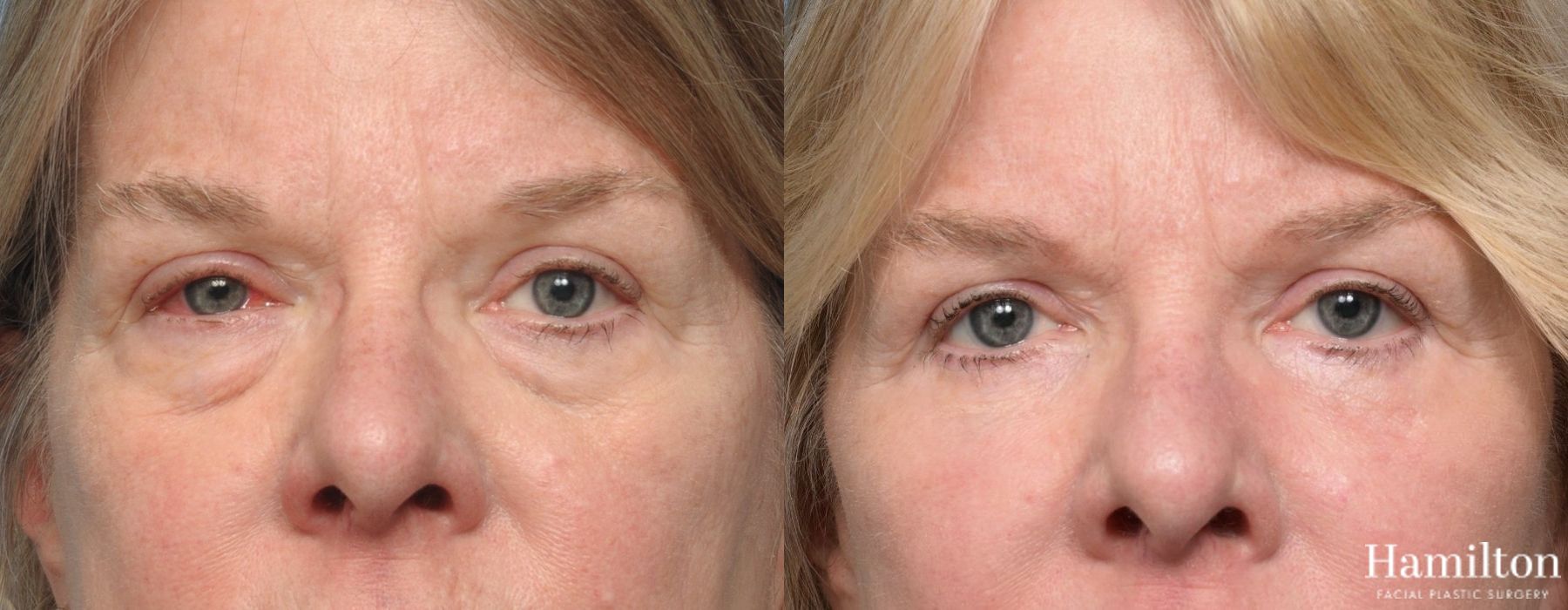Before and after Blepharoplasty case 37230 - Angle 4
