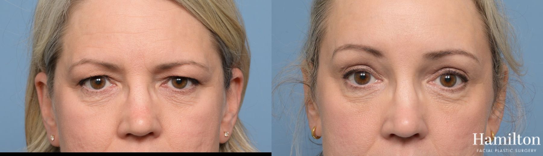 Before and after Blepharoplasty case 37175 - Angle 4
