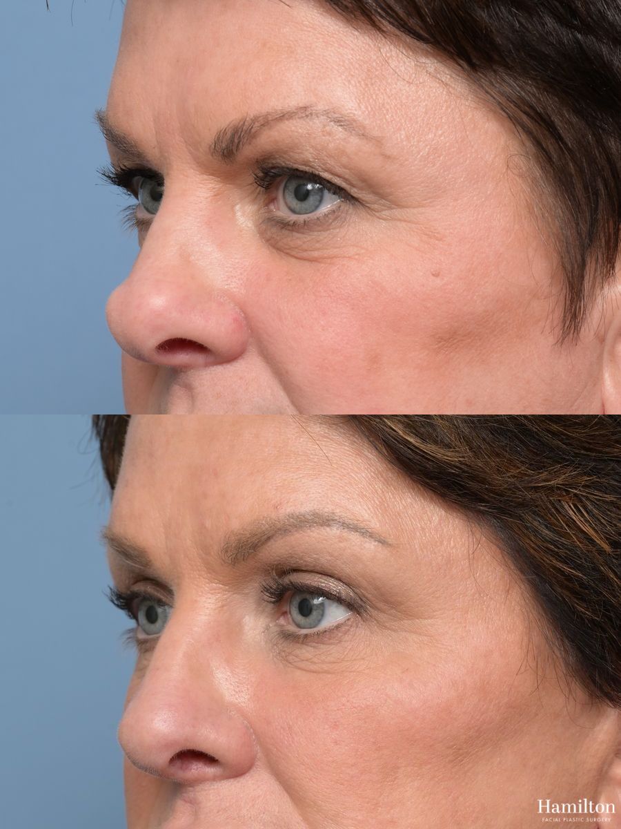 Before and after Blepharoplasty case 49399