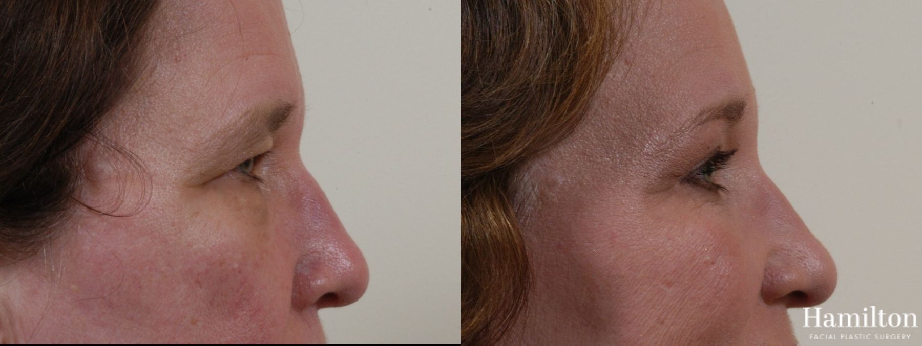 Before and after Blepharoplasty case 37270 - Angle 5