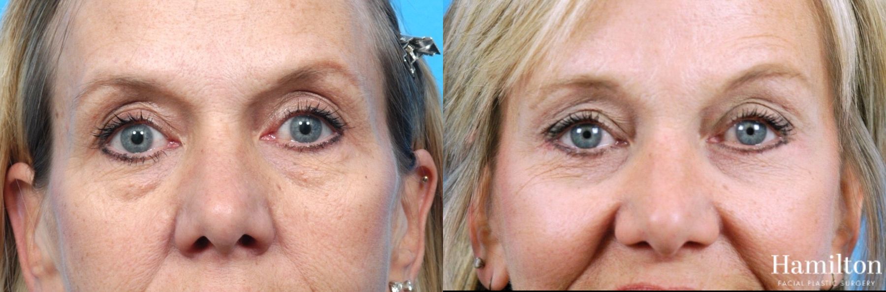 Before and after Blepharoplasty case 37216