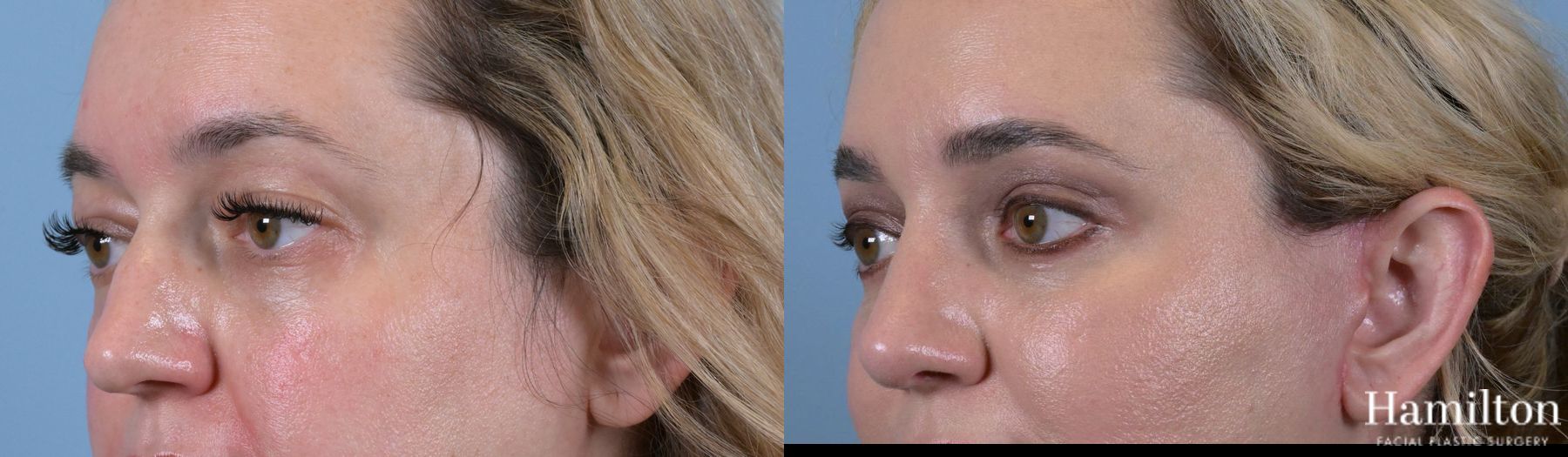 Before and after Blepharoplasty case 37133 - Angle 4