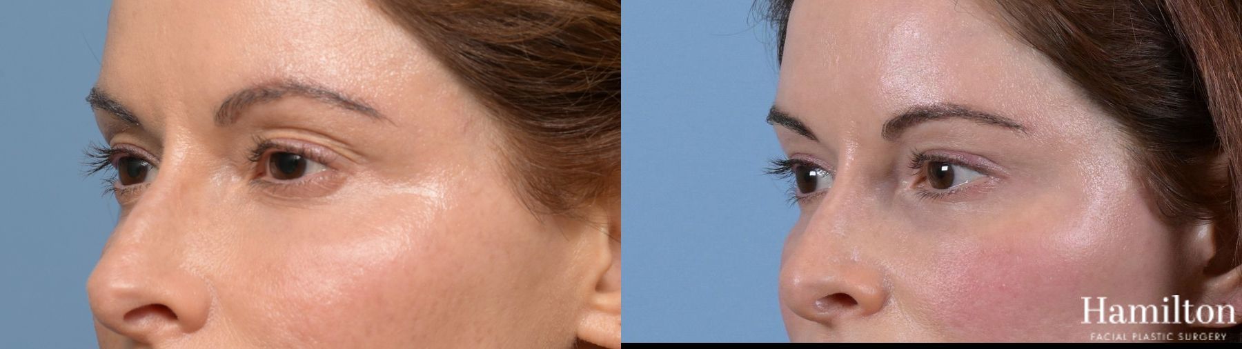 Before and after Blepharoplasty case 37169