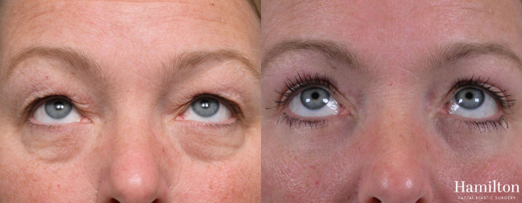 Before and after Blepharoplasty case 37119 - Angle 2