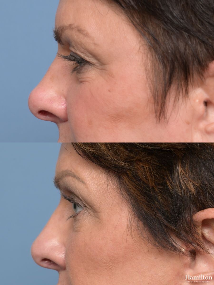 Before and after Blepharoplasty case 49399 - Angle 4