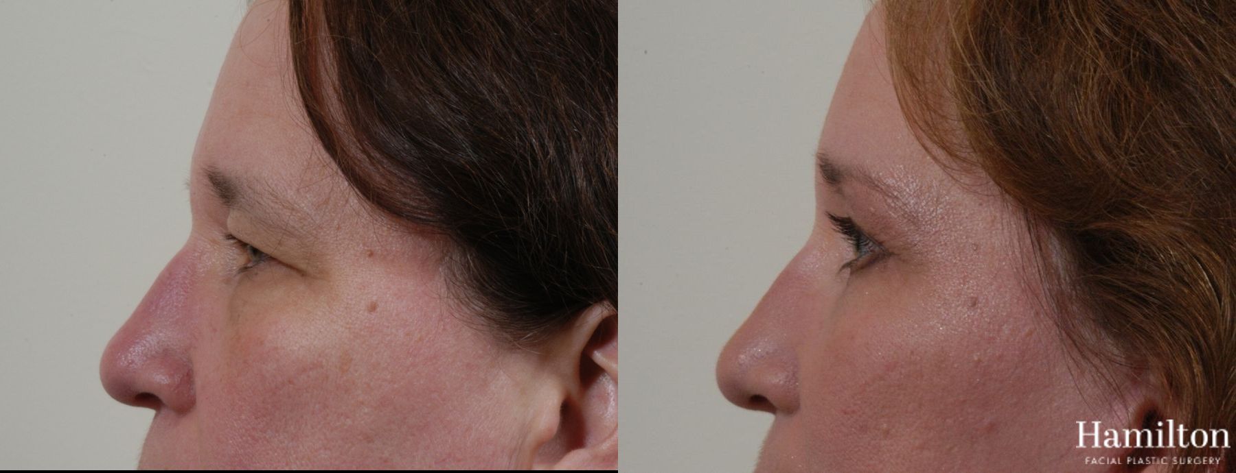Before and after Blepharoplasty case 37270 - Angle 3