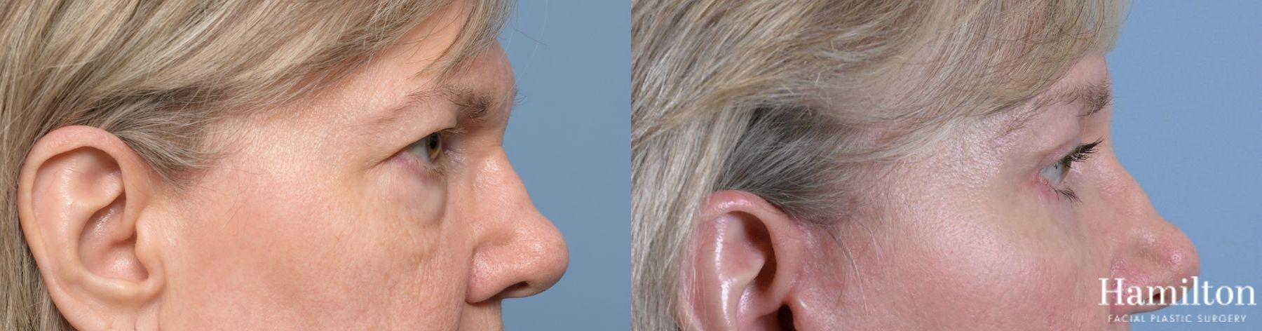 Before and after Blepharoplasty case 37195 - Angle 3