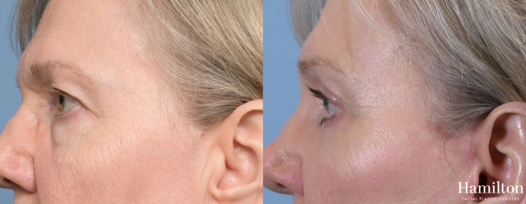 Before and after Blepharoplasty case 37195 - Angle 2