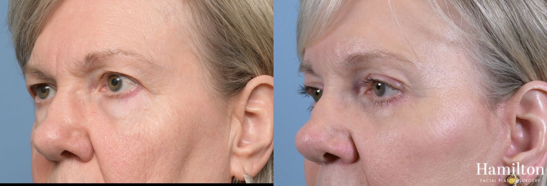 Before and after Blepharoplasty case 37195 - Angle 5