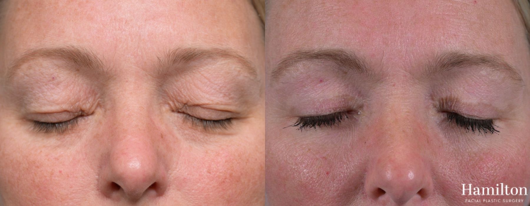 Before and after Blepharoplasty case 37119 - Angle 7