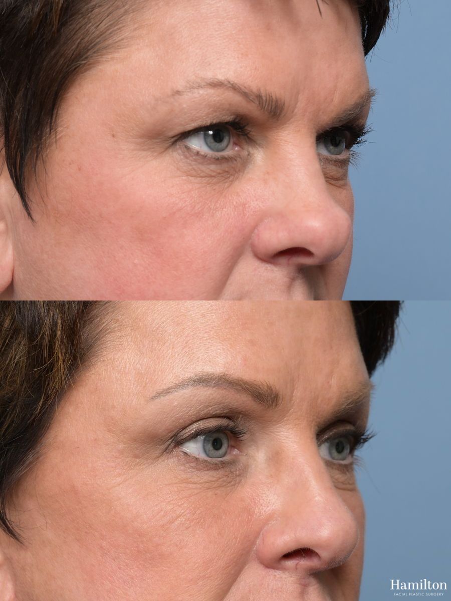 Before and after Blepharoplasty case 49399 - Angle 2
