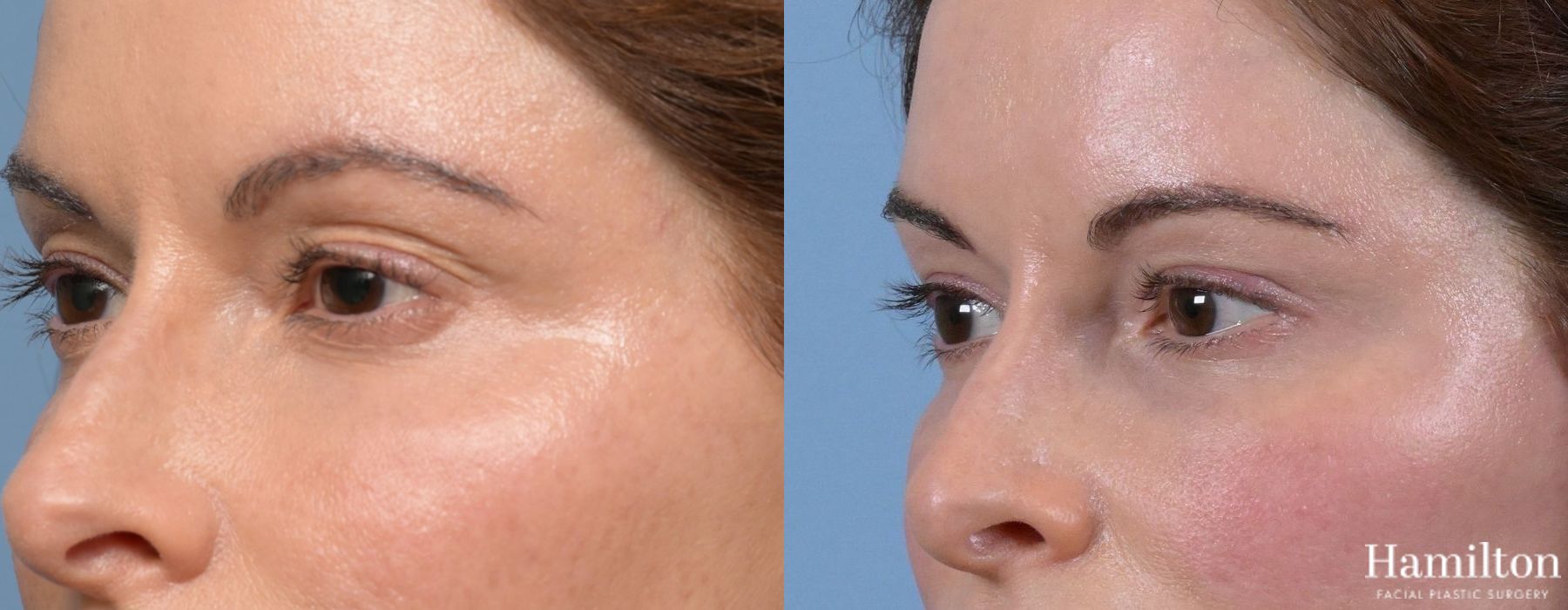 Before and after Blepharoplasty case 37169