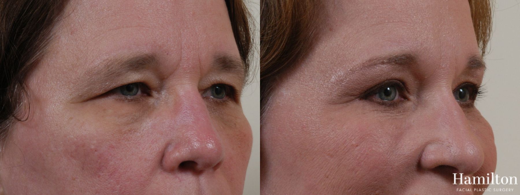 Before and after Blepharoplasty case 37270 - Angle 4