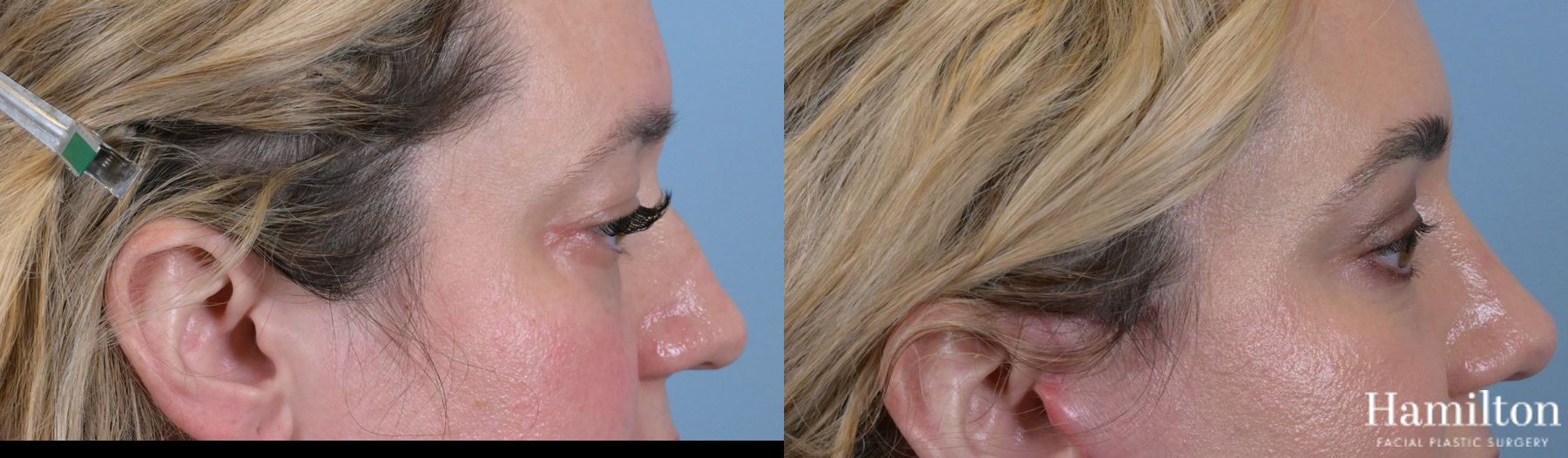 Before and after Blepharoplasty case 37133 - Angle 3
