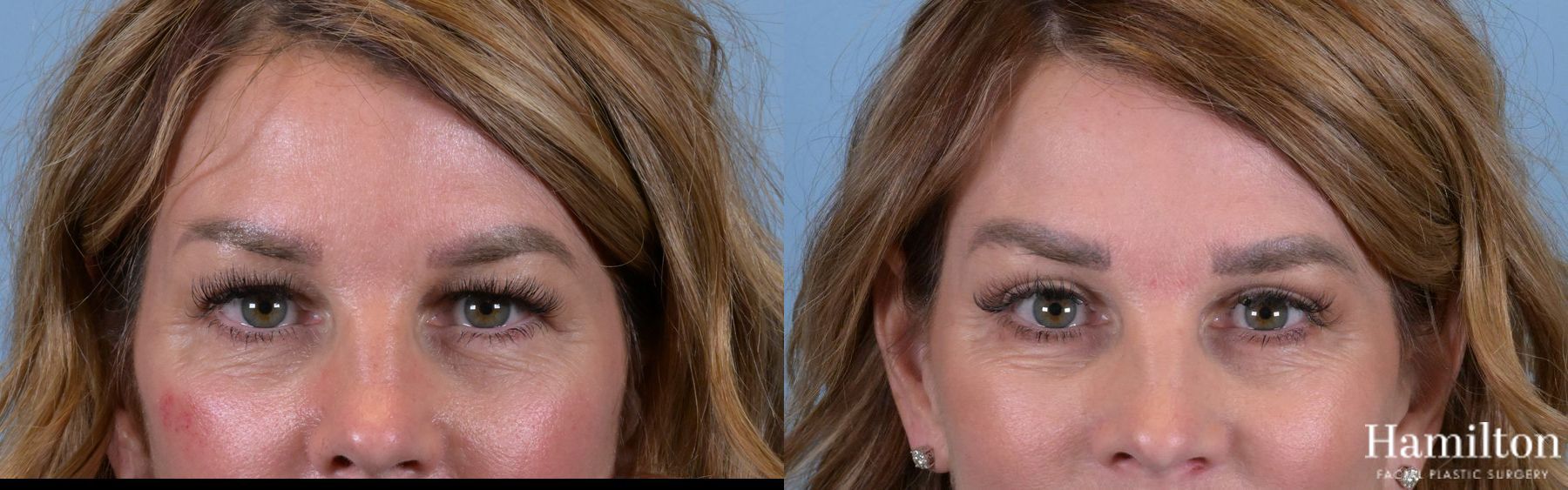 Before and after Blepharoplasty case 37185