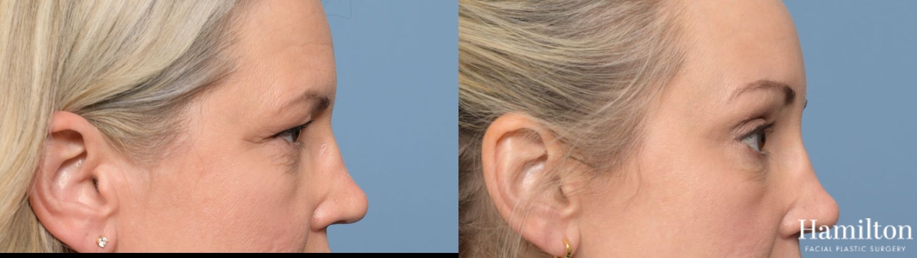 Before and after Blepharoplasty case 37175 - Angle 3