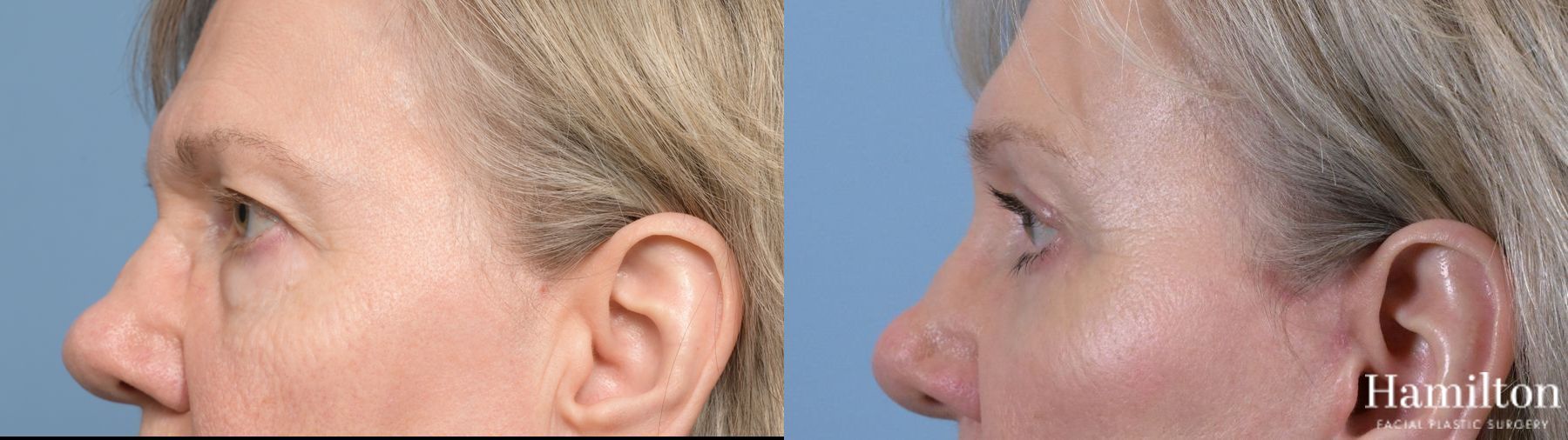 Before and after Blepharoplasty case 37195 - Angle 2