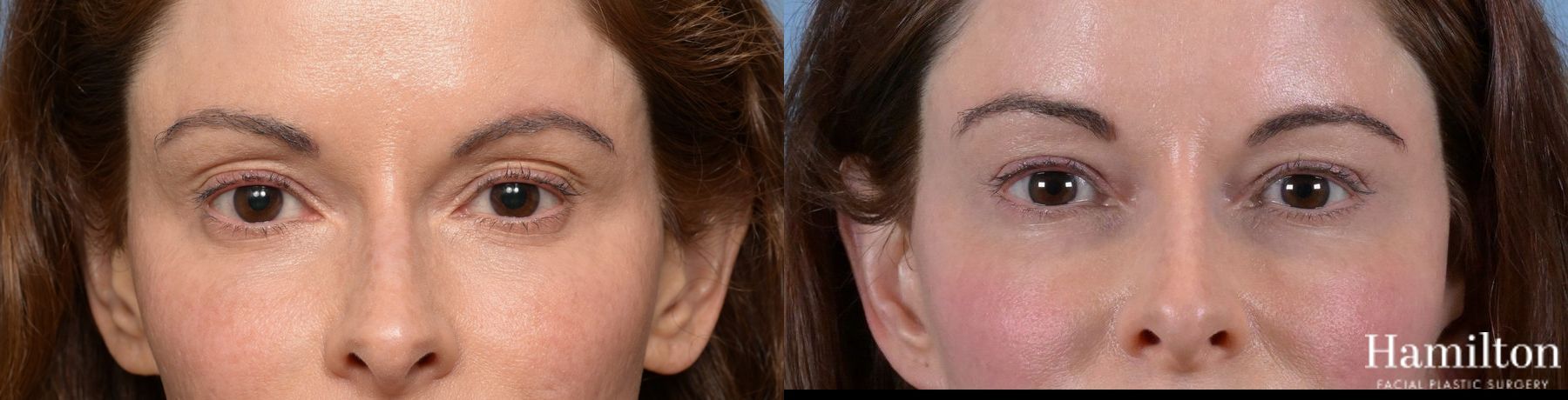 Before and after Blepharoplasty case 37169 - Angle 4