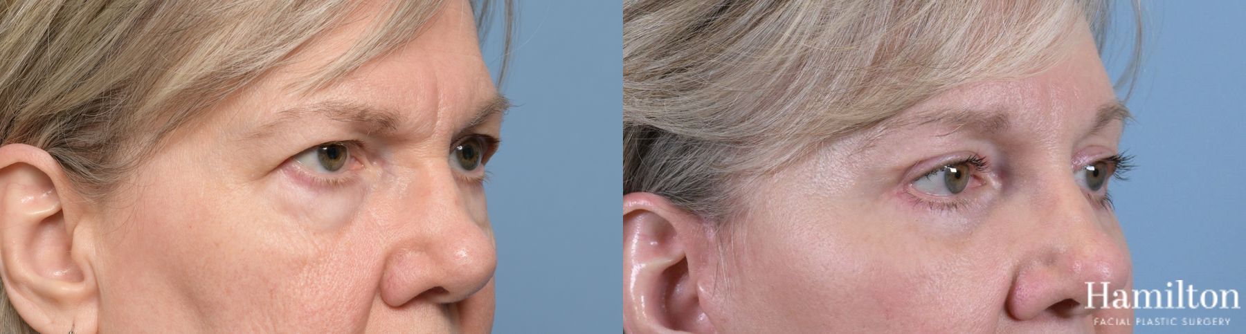 Before and after Blepharoplasty case 37195 - Angle 4