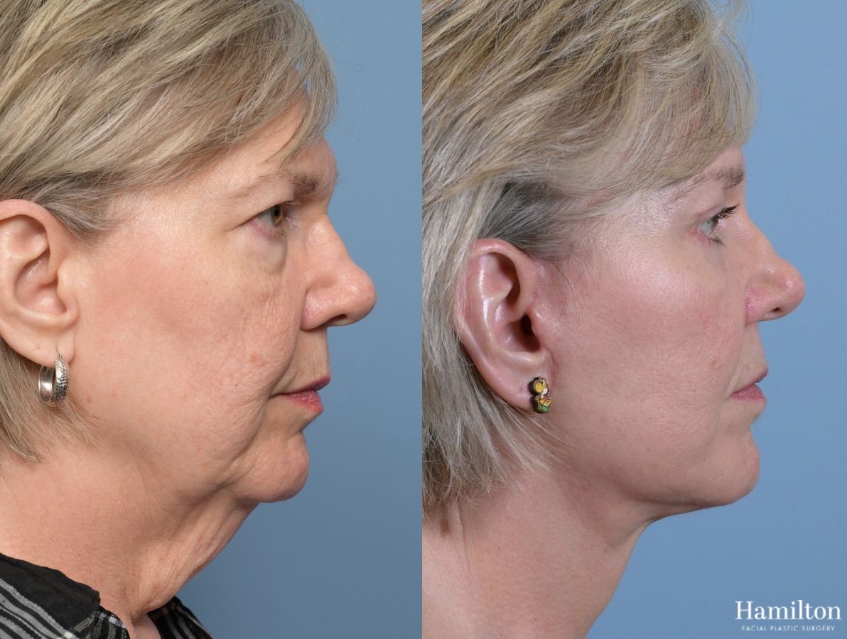 Before and after Brow Lift case 37139 - Angle 2
