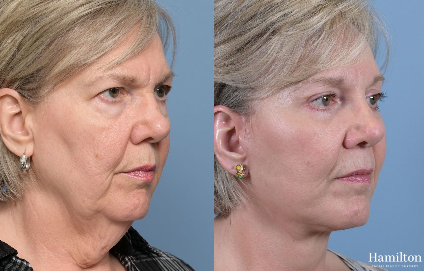 Before and after Brow Lift case 37139 - Angle 3