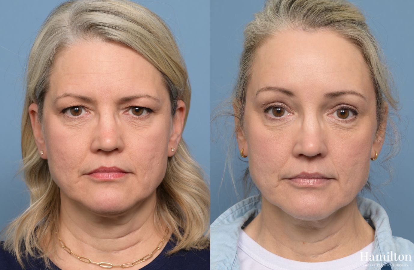 Before and after Brow Lift case 37117