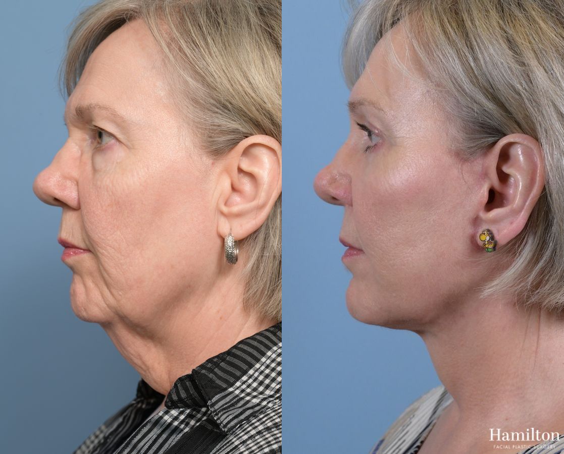 Before and after Brow Lift case 37139