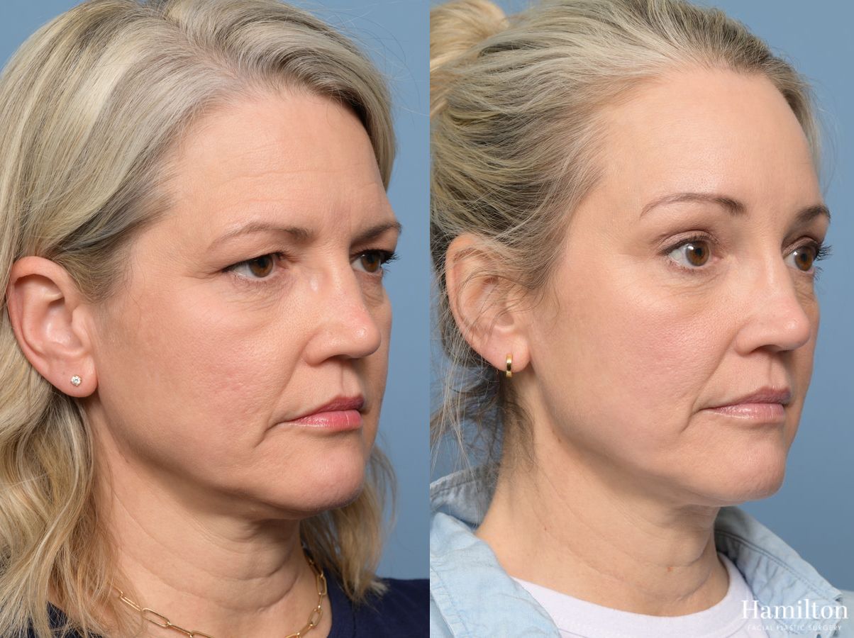 Before and after Brow Lift case 37117 - Angle 3