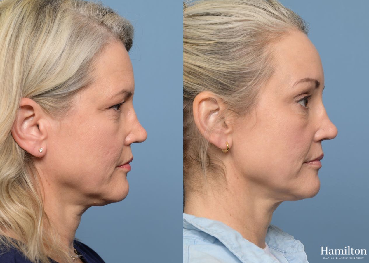 Before and after Brow Lift case 37117 - Angle 5