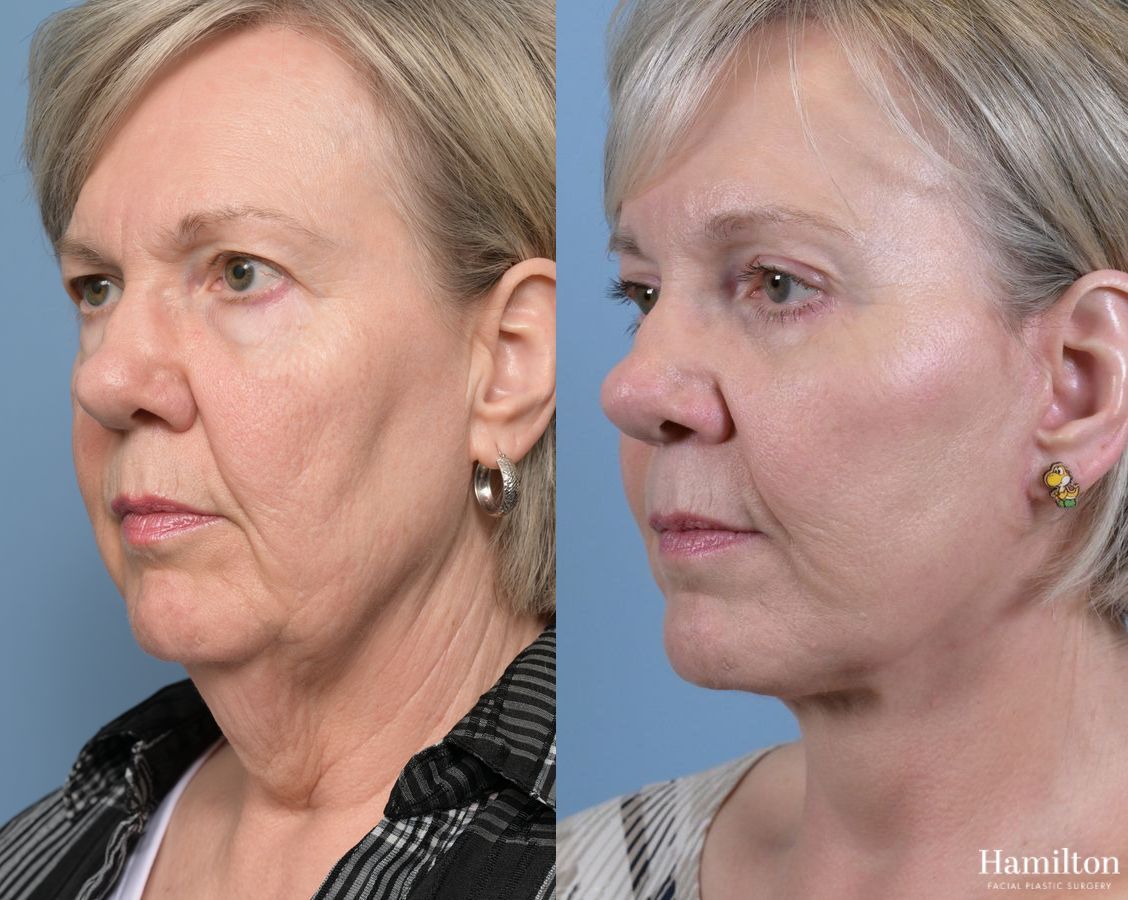 Before and after Brow Lift case 37139 - Angle 4