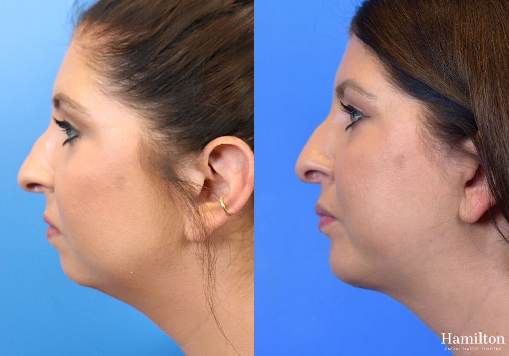 Before and after Chin Augmentation case 37218
