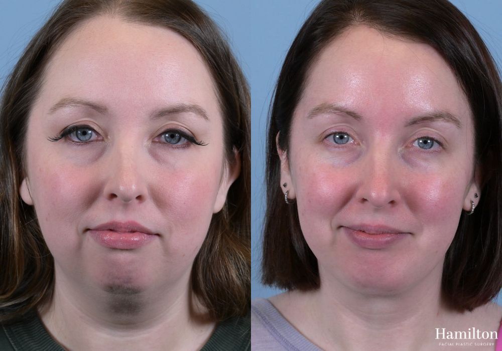Before and after Chin Augmentation case 37114 - Angle 3