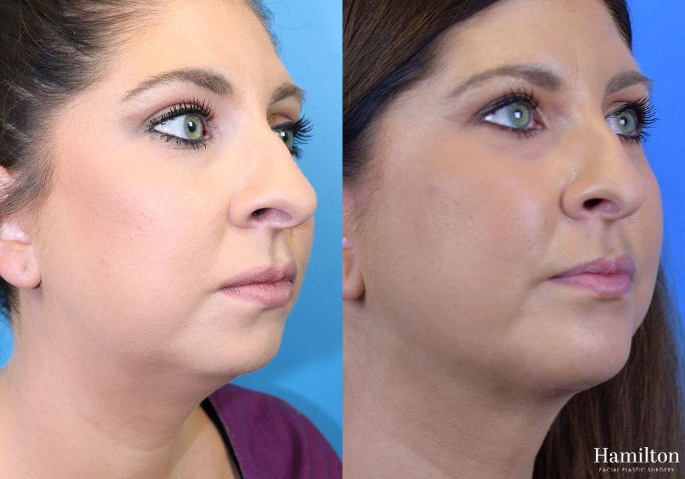 Before and after Chin Augmentation case 37218 - Angle 3