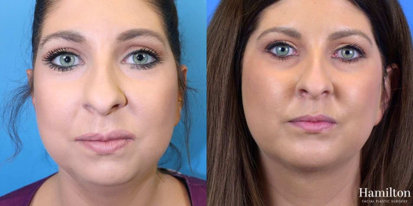 Before and after Chin Augmentation case 37218 - Angle 4
