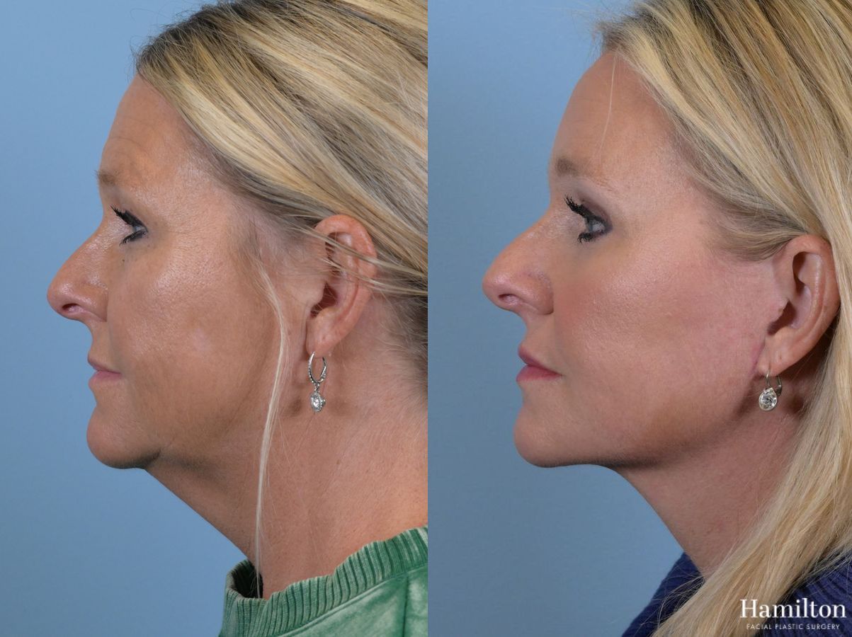 Before and after Laser - MOXI case 37137