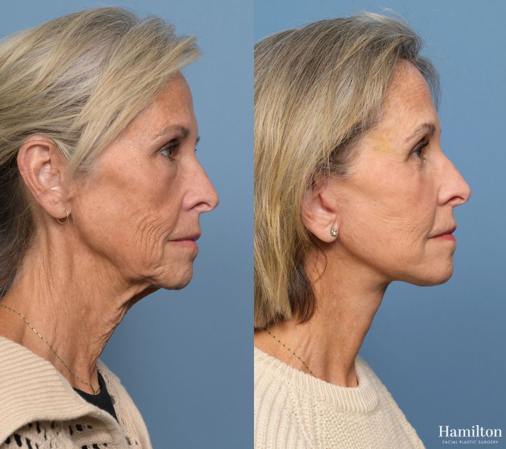 Before and after Facelift case 37219 - Angle 3