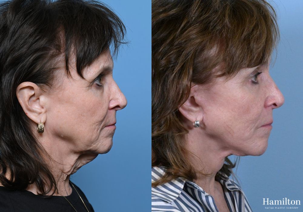 Before and after Facelift case 37338 - Angle 4