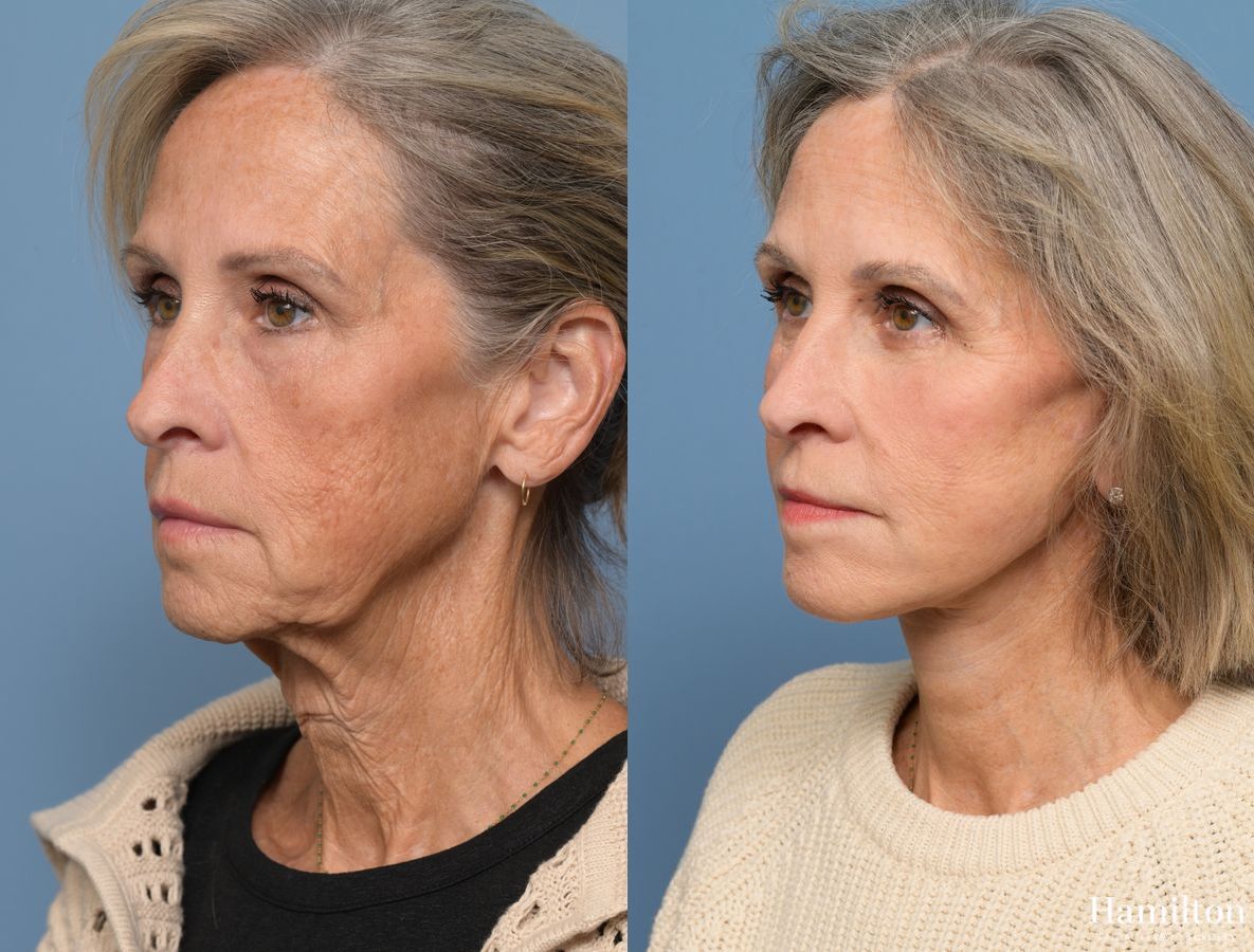 Before and after Facelift case 37219 - Angle 4