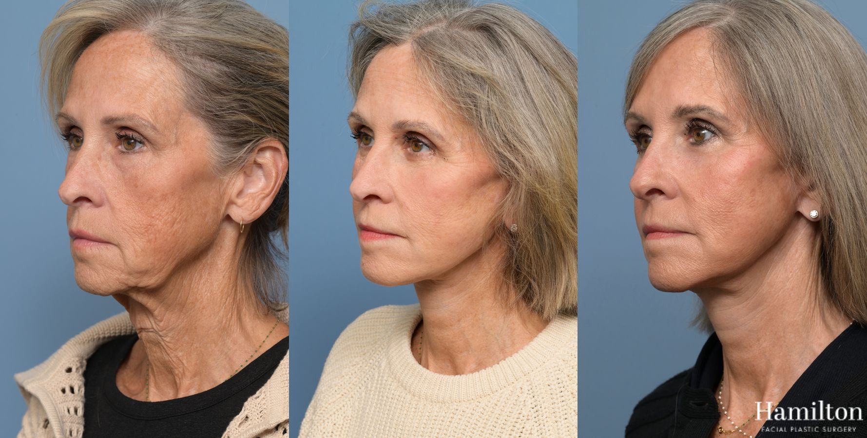 Before and after Facelift - Extended Deep Plane case 37219 - Angle 4