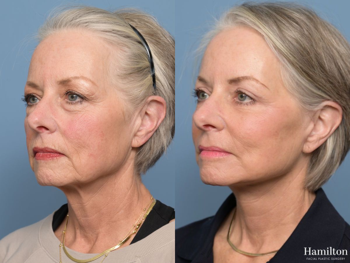 Before and after Facelift - Extended Deep Plane case 43412 - Angle 5