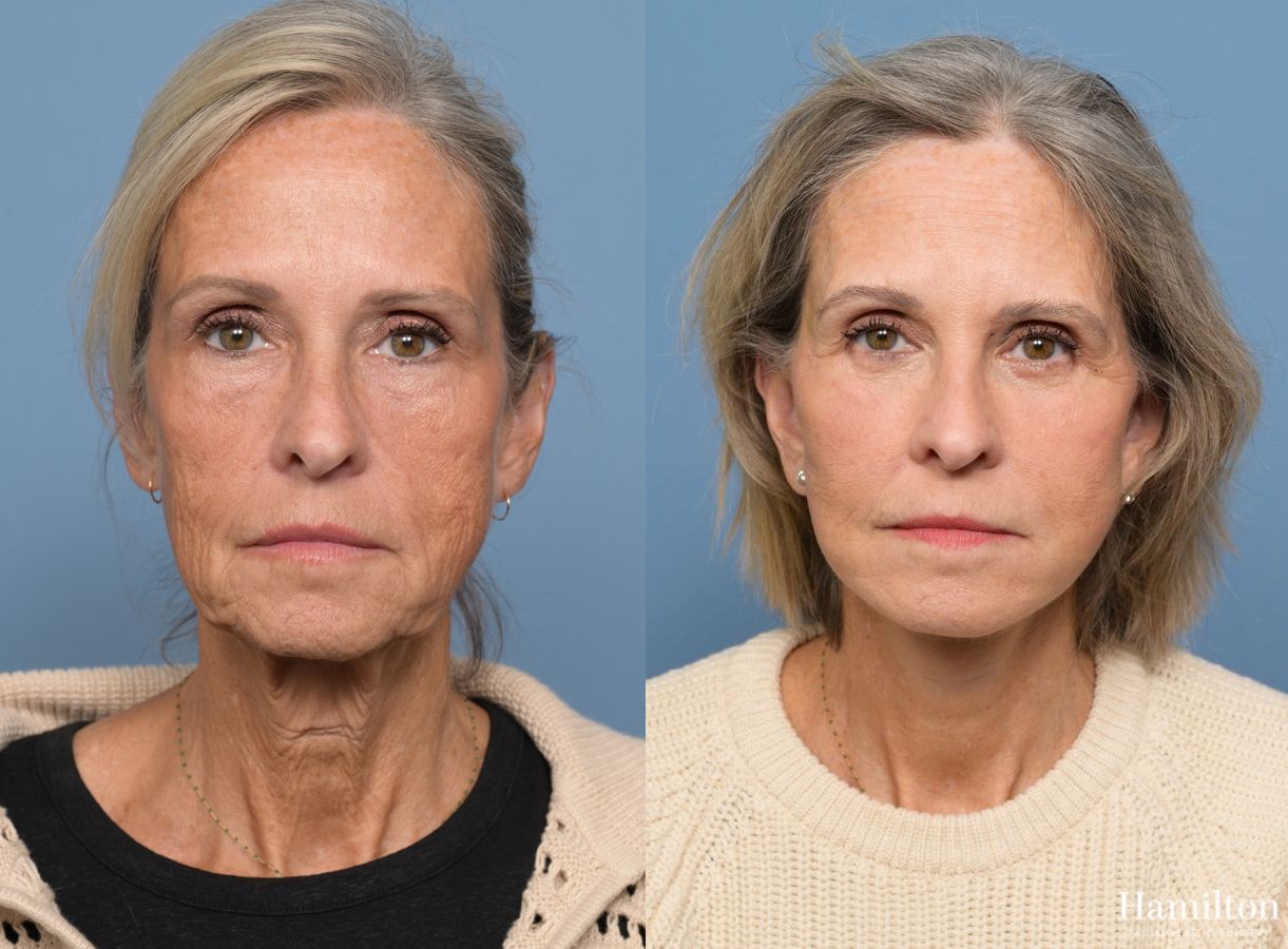 Before and after Facelift case 37219