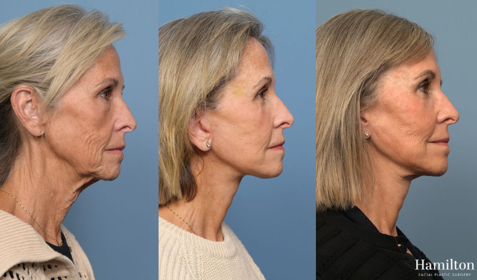 Before and after Facelift - Extended Deep Plane case 37219 - Angle 3