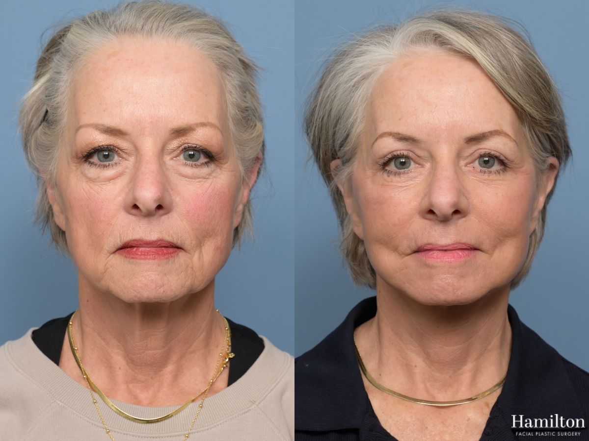 Before and after Facelift - Extended Deep Plane case 43412