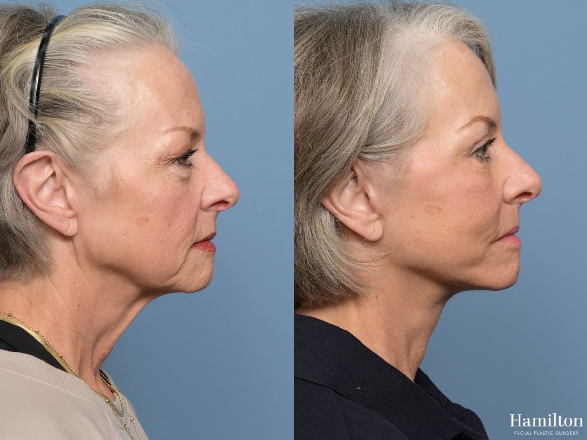 Before and after Facelift - Extended Deep Plane case 43412 - Angle 4