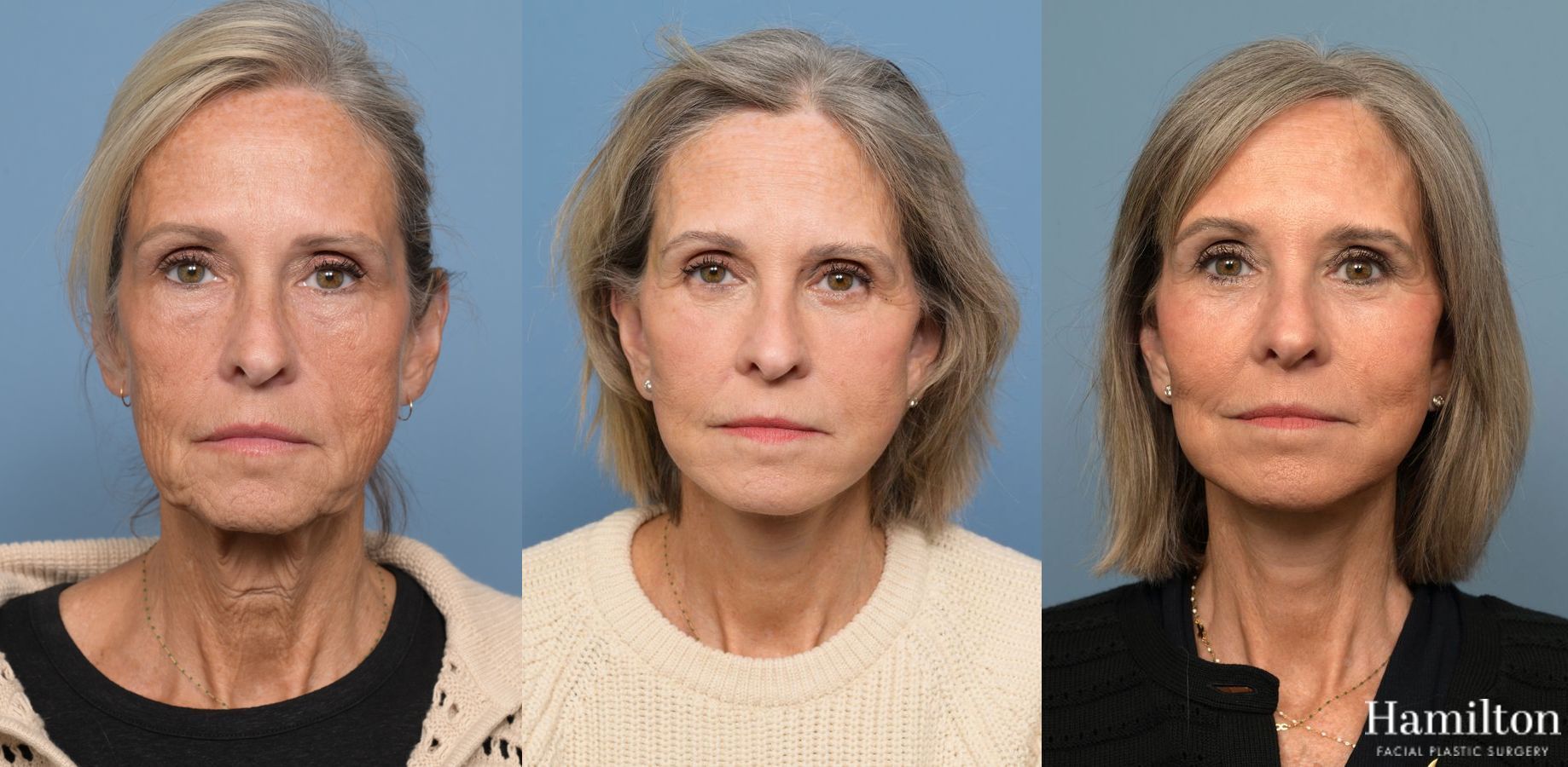 Before and after Facelift - Extended Deep Plane case 37219
