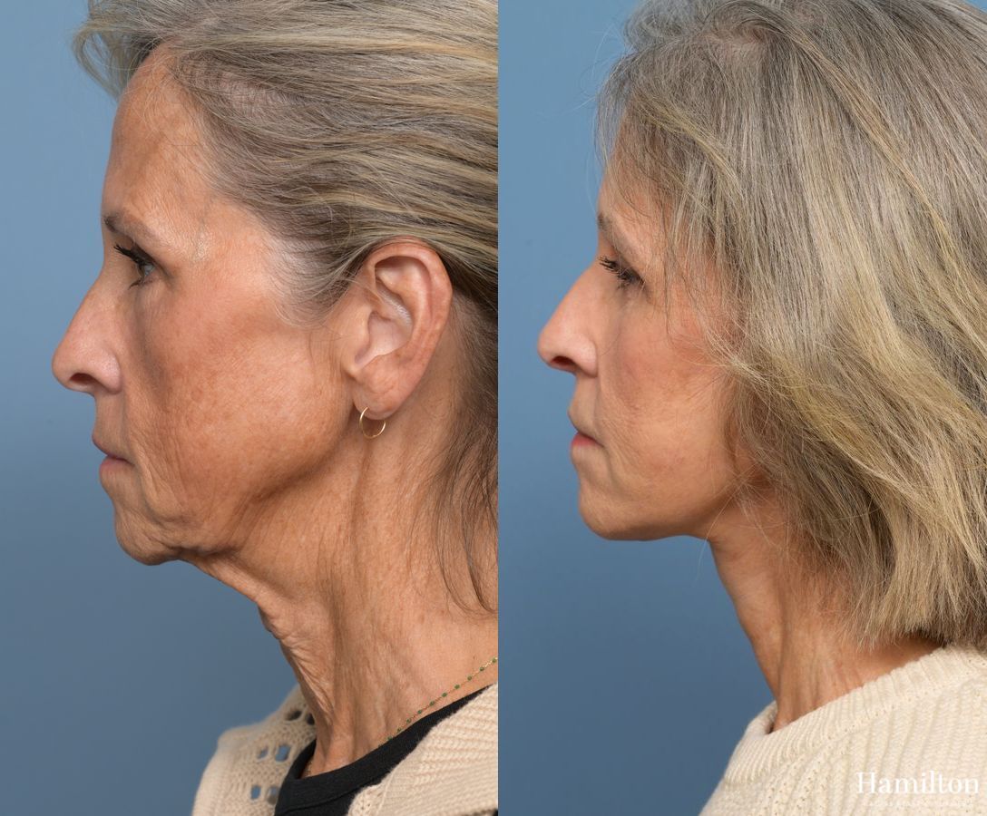 Before and after Facelift case 37219 - Angle 5