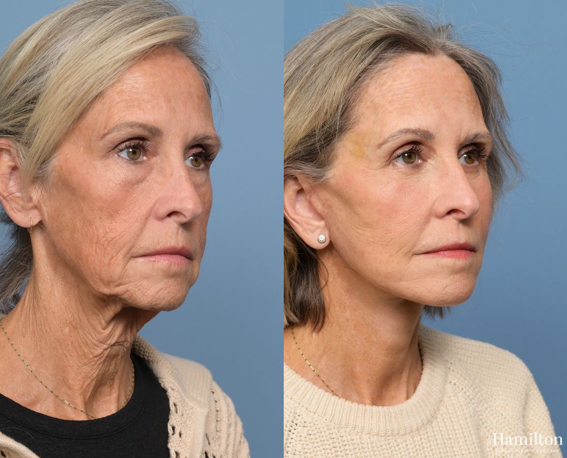 Before and after Facelift case 37219 - Angle 2