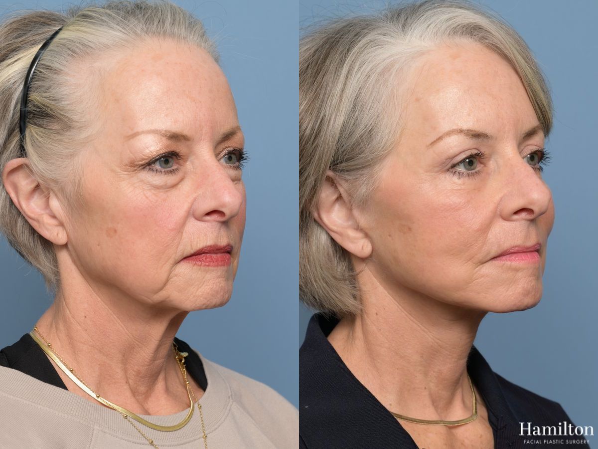 Before and after Facelift - Extended Deep Plane case 43412 - Angle 3